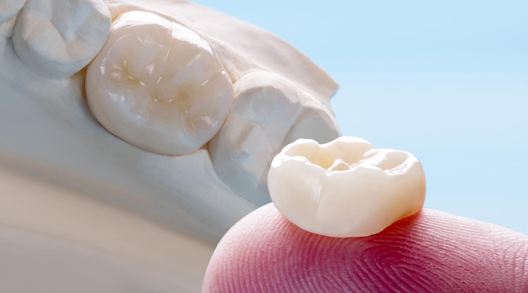 Zirconia Crowns and Bridges